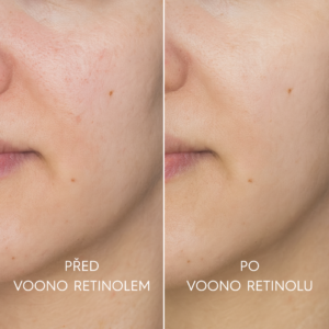 CZ_Retinol