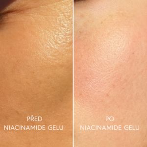 gel s niacinamidem - CZ