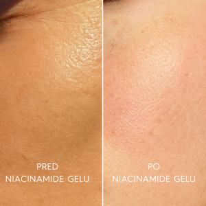 gel s niacinamidem - SK