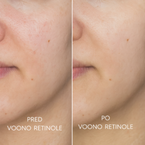 SK_RETINOL