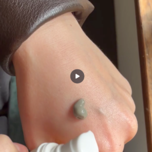 acne spot  cover