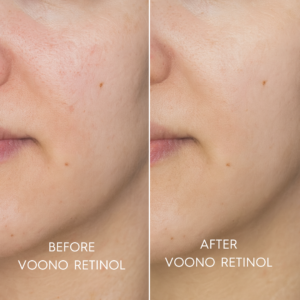 ENG_RETINOL